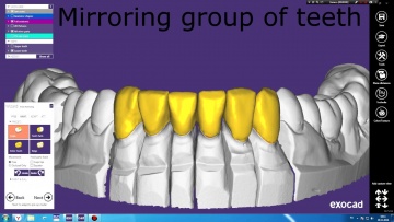 Exocad: зеркальное копирование группы зубов